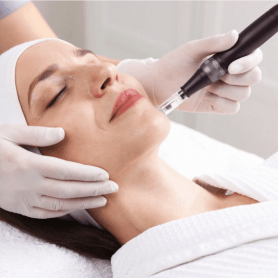 Microneedling with PRP x 3 at Luna Aesthetics in Alexandria, VA