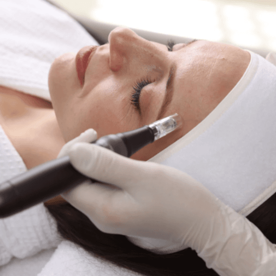 Microneedling + Salmon  DNA x 3 at Luna Aesthetics in Alexandria, VA